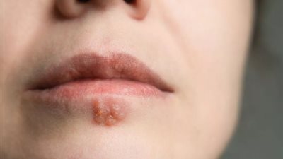 دراسة تكشف: علامات تظهر على الشفاه تشير للإصابة بالخرف 