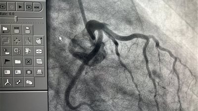 حشيش الوقفة.. مسئول بمستشفى الزيتون التخصصي يحذر: استقبلنا حالات خطيرة لشباب كادوا أن يفارقوا الحياة