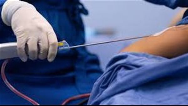 شفط دهون -أرشيفية