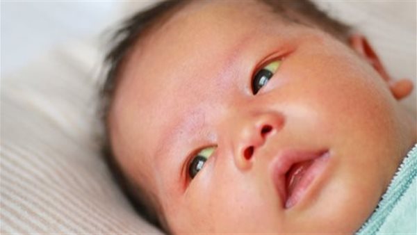 يرقان الرضع