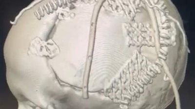 نجاح جراحة دقيقة لزرع عظام الجمجمة لمريضة بمستشفى السنبلاوين