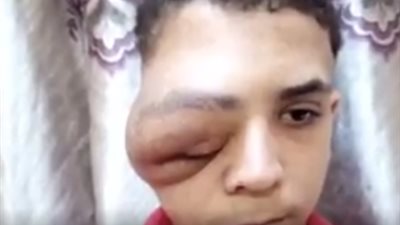 حالة تنمر جديدة.. أب يناشد السيسي لعلاج ابنه: “العيال بيقولوله يا أبو عين” (فيديو)