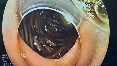 لأول مرة في مصر.. استخدام منظار الأمعاء الدقيقة لتسليك القنوات المرارية (صور)