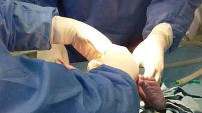 ‎ولادة توأم لسيدة مصابة بفيروس كورونا بمستشفيات جامعة المنصورة