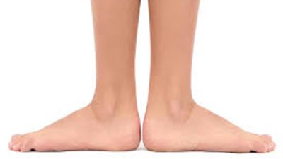 استشاري جراحة عظام: تجاوز الـ21 بدون علاج “الفلات فوت” يقلل من نسبة الشفاء