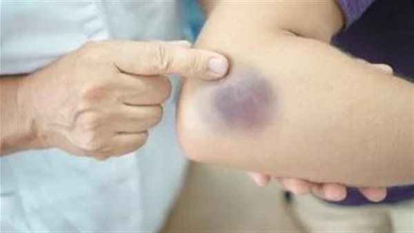 كدمات الجلد ـ تعبيرية