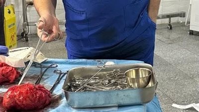 يزن 3 كيلوجرامات.. استئصال ورم ليفي من رحم سيدة في قنا 