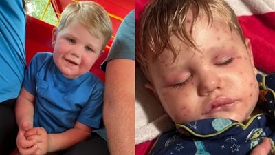 حادثة مأساوية: طفل أمريكي يتعرض لـ 150 لسعة دبور بعد اصطدامه بعش