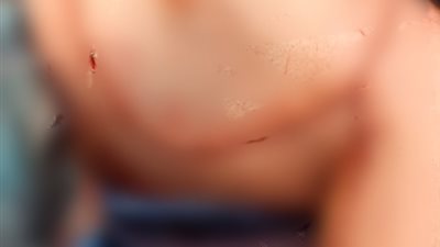  لأول مرة في مستشفيات المنوفية.. إنقاذ ذراع مريض خلال جراحة أعصاب دقيقة