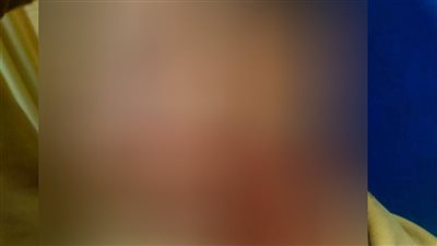 إصابة بالغة لشاب إثر مشاجرة مع زملائه في المنوفية