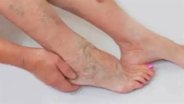 الدوالي ـ تعبيرية