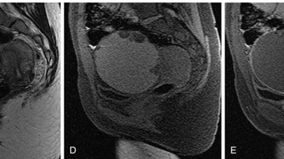 في حالة حرجة.. فريق جراحة الأورام بالسنبلاوين ينجح في استئصال كيس ضخم من حوض مريضة