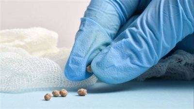 وصفات علاج حصوات المرارة.. نظام غذائي فعال لتقليل الأعراض المؤلمة