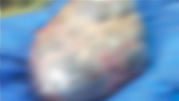 استئصال ورم بالبطن