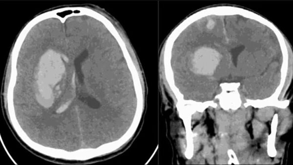 دماغ المُصاب