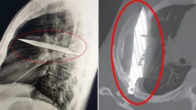 بعد شعوره بالألم.. أطباء يعثرون على سكين عالقة في صدر شخص منذ 8 سنوات