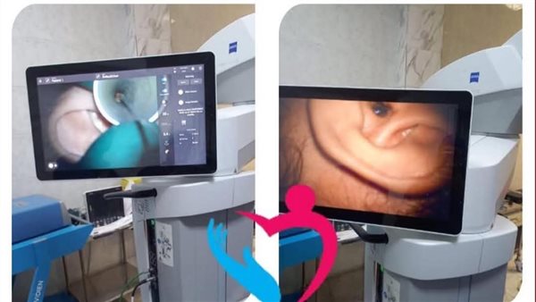 تدخل جراحي بالأذن