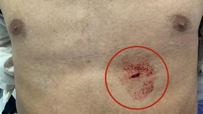 فريق طبي بمستشفى المنصورة الدولي ينقذ شابًا من موت محقق بعد طعنة مباشرة في القلب