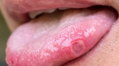 تعرف على أسباب الإصابة بسرطان اللسان