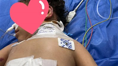 سقطت من علو.. إنقاذ صغيرة بإجراء جراحة دقيقة بمستشفى بني عبيد التخصصي في الدقهلية