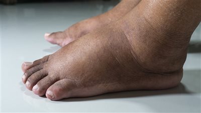 أسباب تورم الرجلين وطرق العلاج الطبيعية.. كيفية التخلص من الوذمة