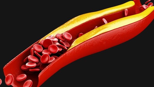 الكوليسترول 