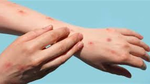  متلازمة اليد والقدم