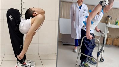 معجزة طبية في الصين.. شاب منحنٍ كحرف Z يقف مستقيمًا لأول مرة بعد 21 عامًا