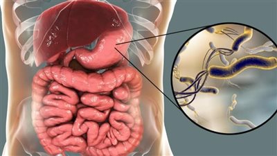 أسباب جرثومة المعدة وأعراضها النفسية والعضوية.. كلمة السر بكتيريا الملوية البوابية 