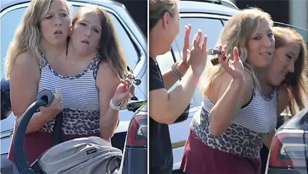 التوأم الملتصق آبي