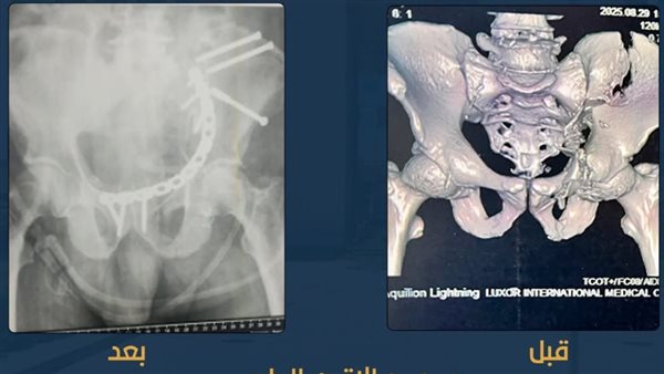 عملية جراحية ناجحة