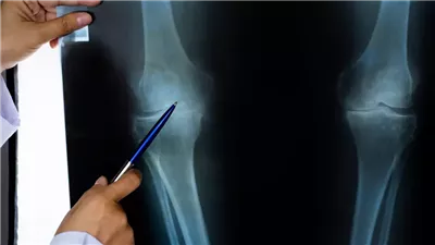 سببان رئيسيان وراء تزايد مشكلات الركبة بين الشباب