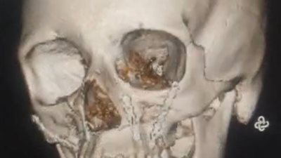 جراحة دقيقة تعيد الابتسامة لمريضة بعد إصابة خطيرة بالفك في مستشفى ميت غمر بالدقهلية