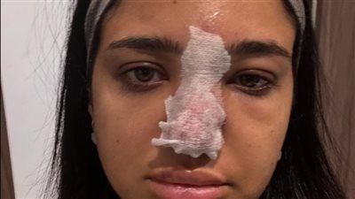 تعرضت لمضاعفات خطيرة.. البلوجر كنزي مدبولي: مناخيري كانت هتروح بسبب حقنة فيلر