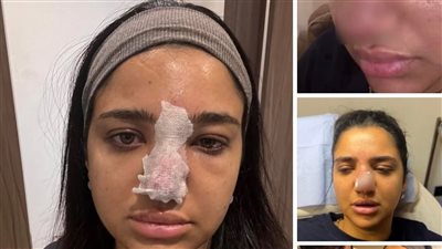 بعد أزمة كنزي مدبولي.. أستاذ جراحة تجميل يحذر: حقن الفيلر في الأنف قد تسبب تشوهات خطيرة