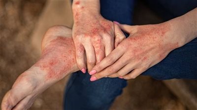 في اليوم العالمي للأكزيما 2025.. تعرف على أسباب الإصابة والأعراض