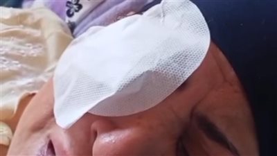 سيدة تفقد بصرها بعد عملية مياه زرقاء بمستشفى رمد المحلة.. ومحضر رسمي لإثبات الواقعة