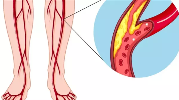  انسداد الشرايين