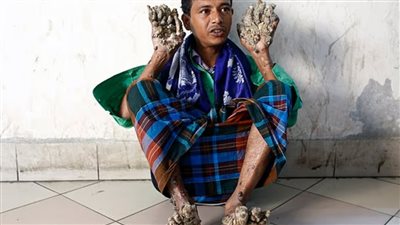 متلازمة الرجل الشجرة.. مرض نادر يثير الجدل في بنجلادش 
