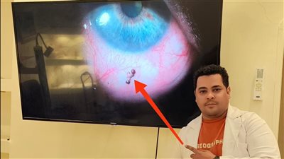 طبيب أقصري ينقذ مريضة من نملة.. مختبئة داخل عينها منذ 3 أيام 