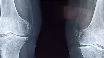 الصين تطور غراء عظام ثوري يُصلح الكسور في 3 دقائق ويغني عن الجراحة التقليدية