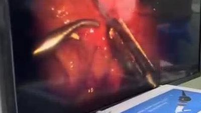 أطباء بنها ينقذون صغيرًا من عيب نادر بالقصبة الهوائية والمريء