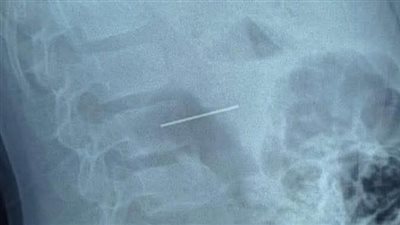 استخراج مسمار دباسة من بطن طفل في عملية نادرة بمستشفى الأطفال التخصصي ببنها