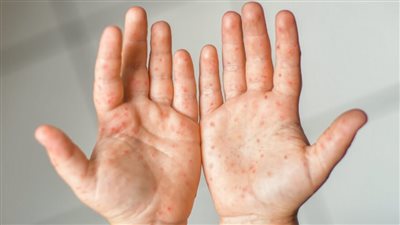 استشاري طب أطفال يوضح طرق الوقاية من متلازمة اليد والقدم والفم 