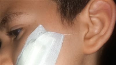 ضربه بـ كتر داخل الفصل.. طالب بالصف الثالث الابتدائي يصيب زميله بعاهة مستديمة في مدرسة بحلوان