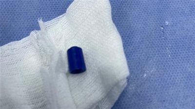 استخراج «لبيسة قلم» من الشعب الهوائية لصغير في طنطا بعد ابتلاعها خلال المذاكرة