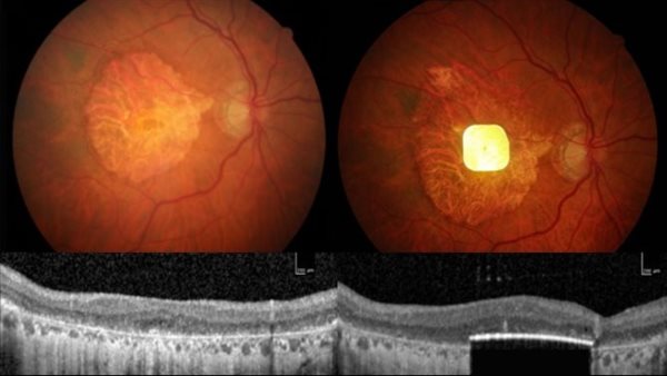 زراعة عين إلكترونية