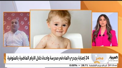 نائب رئيس قسم المحافظات بـ القاهرة 24 يوضح لـ قناة العربية تفاصيل حالات الجديري بمدرسة في المنوفية