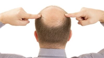 مصل طبيعي جديد من جامعة تايوان قد يغيّر مستقبل علاج تساقط الشعر