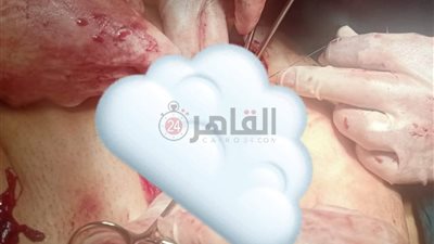 تدخل طبي دقيق ينقذ حياة مصابة بمشيمة مخترقة للرحم في المنوفية